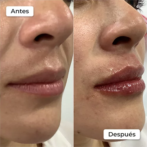 Rejuvenecimiento facial antes y después 1