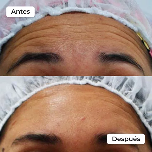 Rejuvenecimiento facial antes y después 2