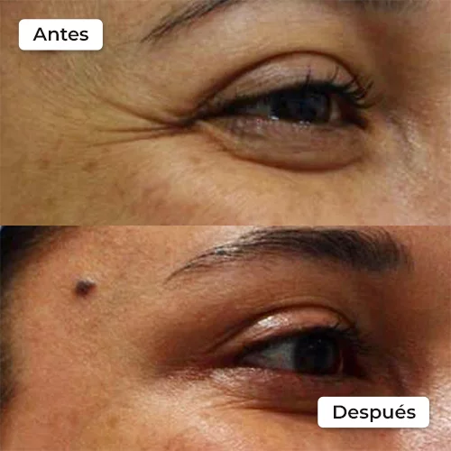 Rejuvenecimiento facial antes y después 3