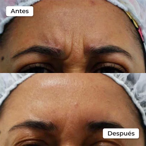 Rejuvenecimiento facial antes y después 4