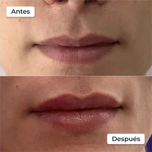 Rejuvenecimiento facial antes y después 5