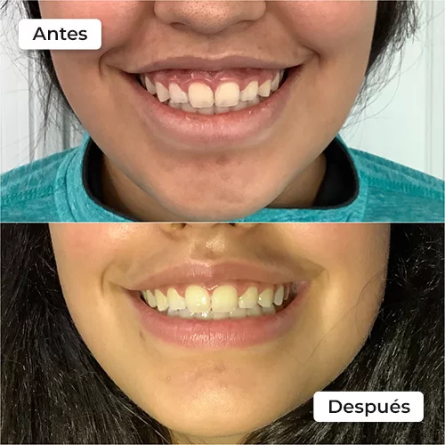 Rejuvenecimiento facial antes y después 6