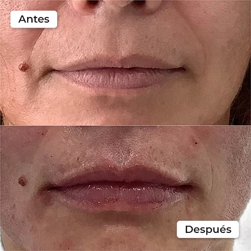 Rejuvenecimiento facial antes y después 7