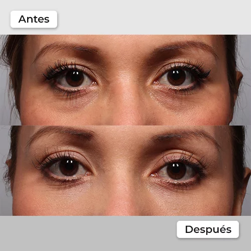 Rejuvenecimiento facial antes y después 8