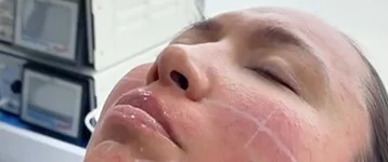 Rejuvenece con aplicación de ácido hialurónico
