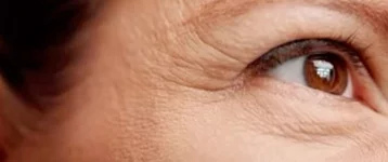 Rejuvenece con aplicación de toxina botulínica